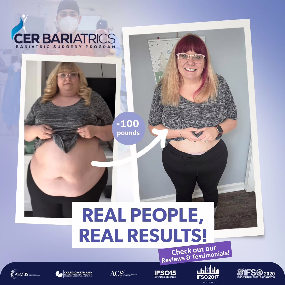 before-after-weight-loss-surgery