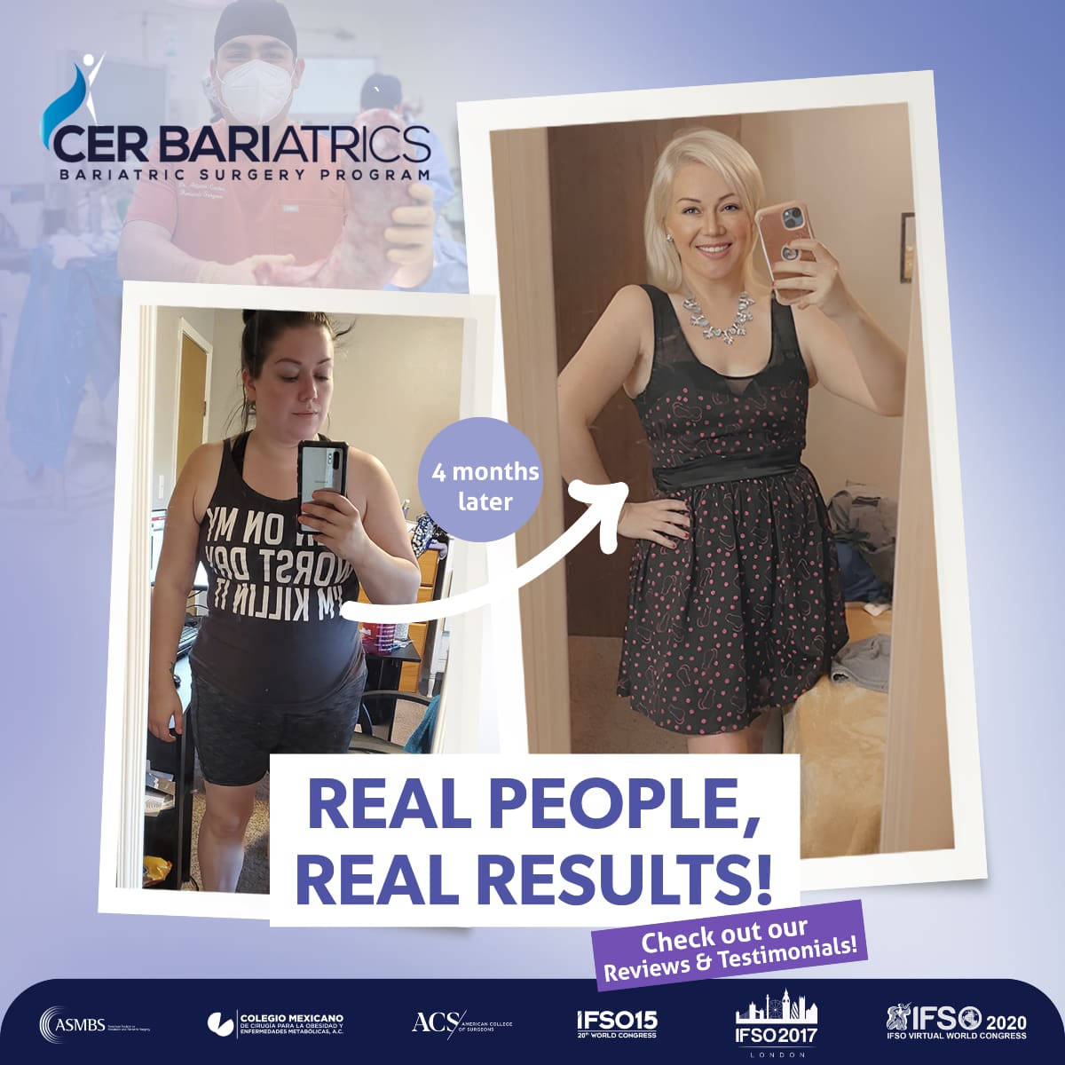 before and after surgery cer bariatrics mexico