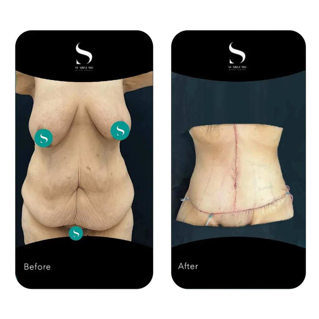 Before/After - 2
